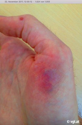 Verletzung an der Hand