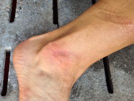 Bein mit Druckstelle